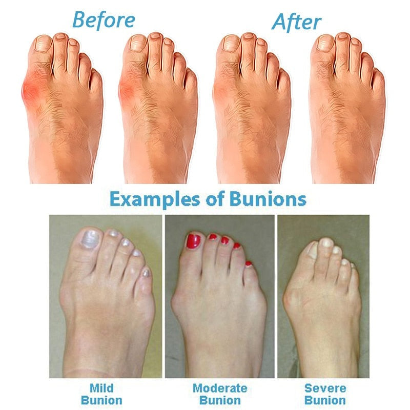 Comfortable Women's Orthopedic Sandals for Bunion Relief